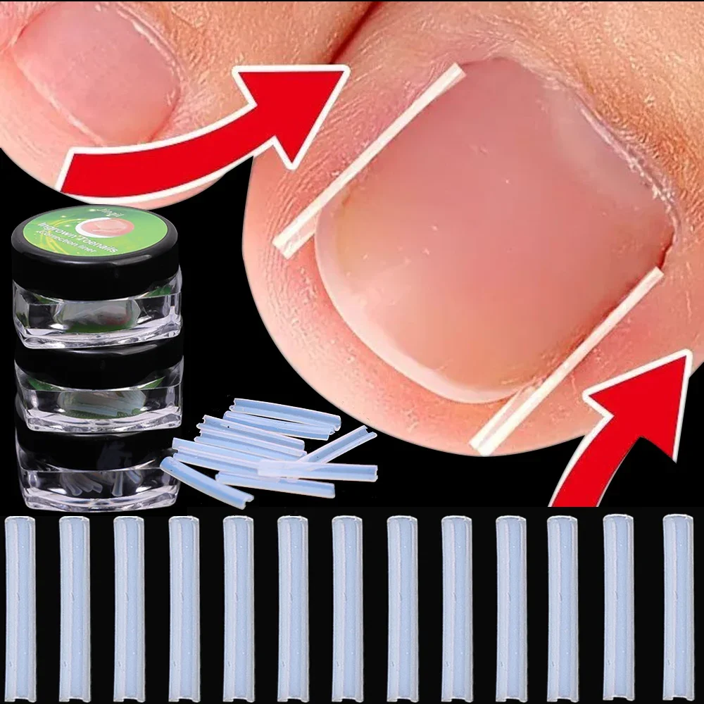 1-100PCS Ingrown Toenail Correction Ultra-thin Nail Treatment Elastic Patch Sticker Straightening Nails Groove Ingrown Corrector 1-100PCS