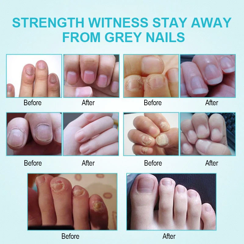 Cura delle unghie Soluzione per il trattamento dei funghi Mani Piedi Anti-Infezione Ispessimento delle unghie Curling Peeling Atrofia Onicomicosi 3ml