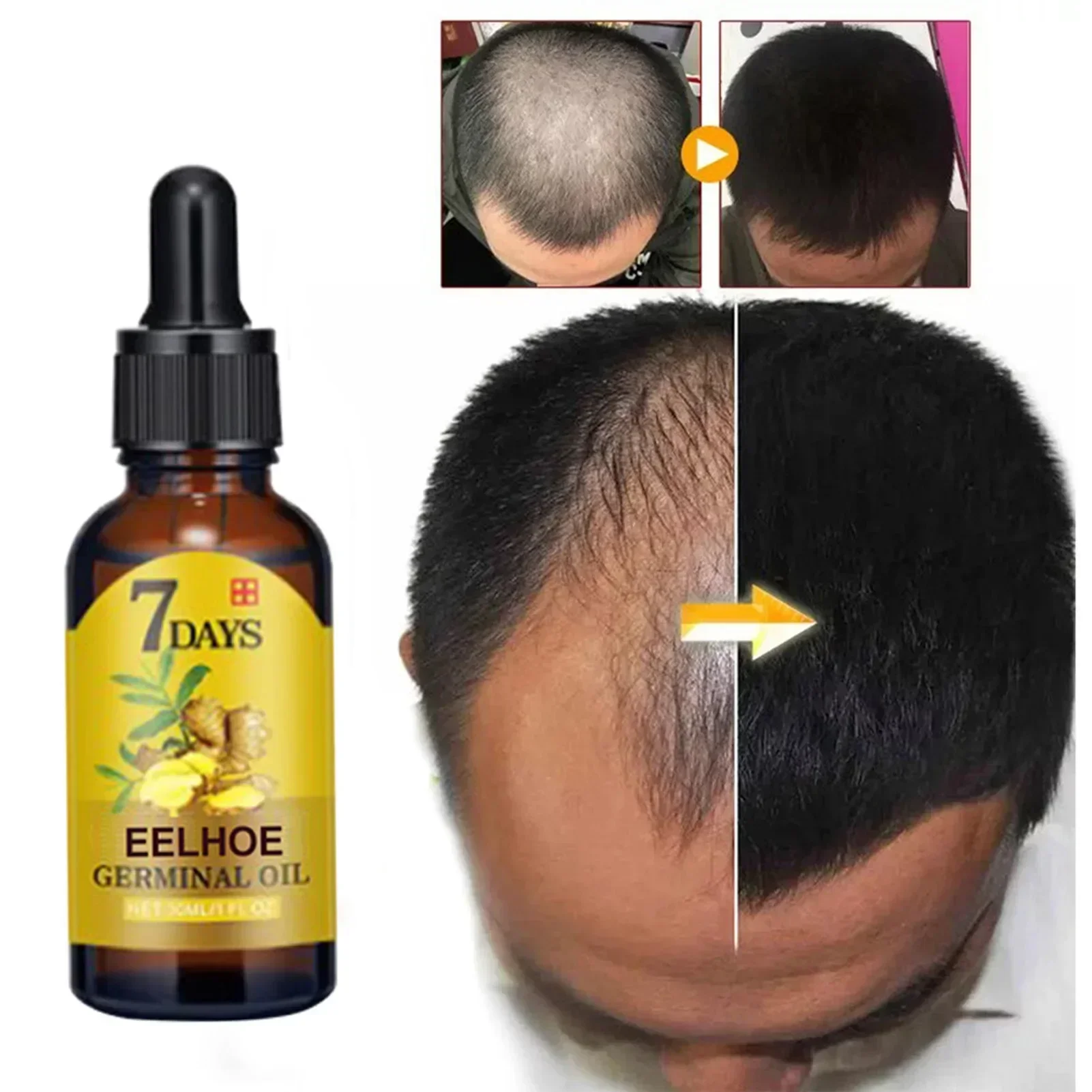 Suero para el crecimiento del cabello, aceites esenciales para el crecimiento rápido del cabello de 7 días, 10/20/40ml, crecimiento denso, cabello de jengibre, favorece el aceite germinal regenerador