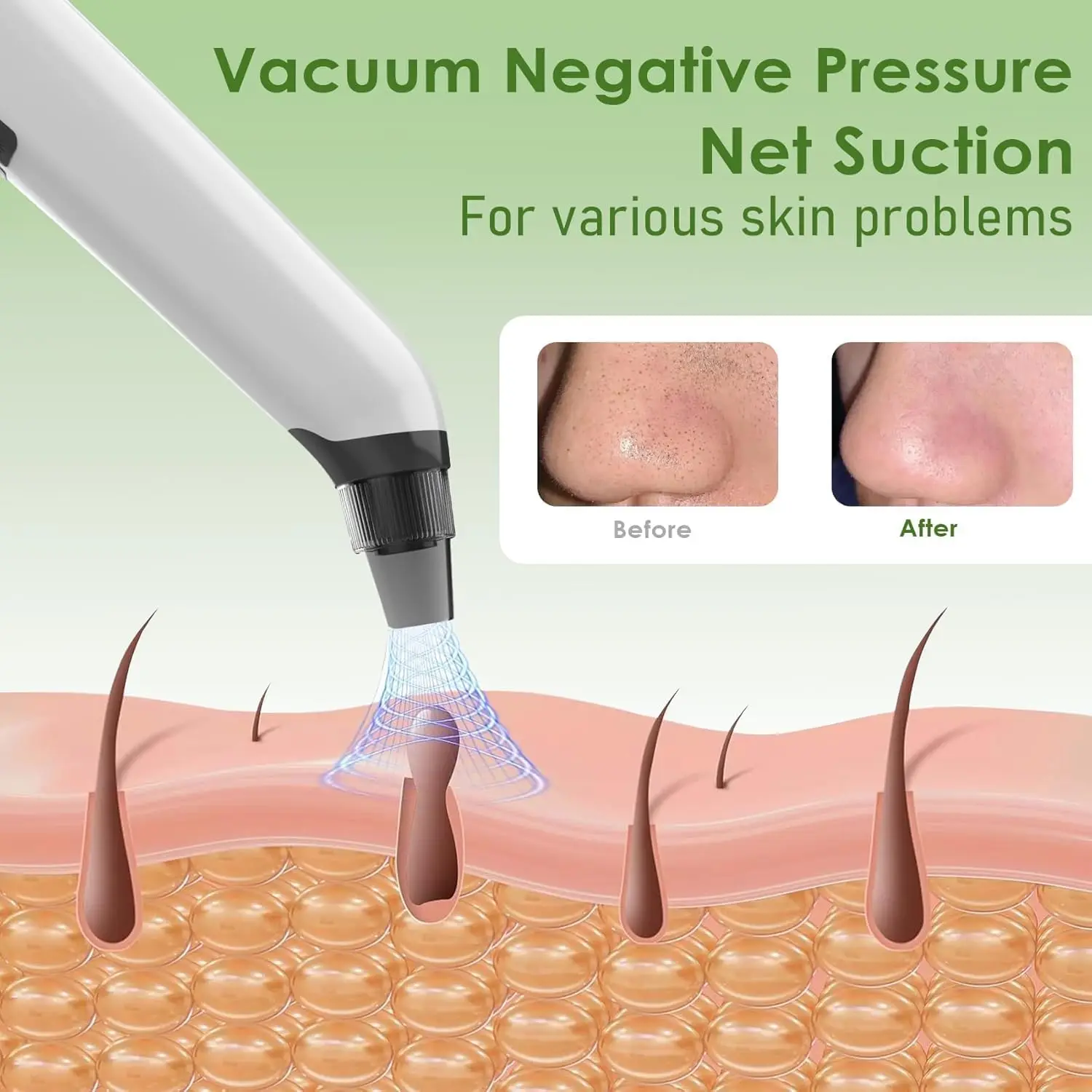 Heet Kompres Facial Comedondrukker Vacuüm Zuig Acne Porie Schoner Tool Elektrische Neus Gezicht Diepe Reiniging Huidverzorging Apparaat