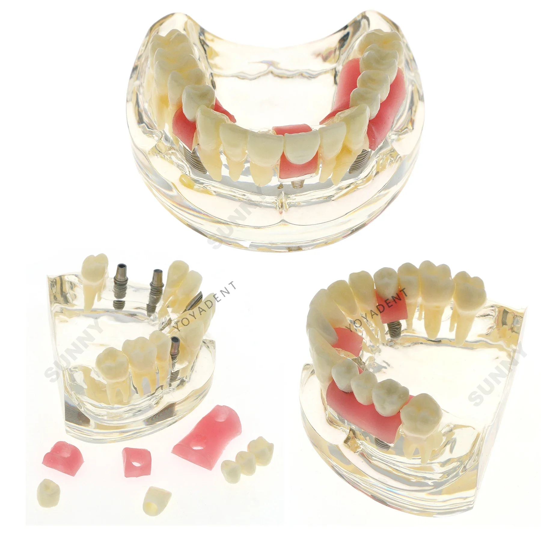 

Dental Teeth Model Implant With Bridge Caries Dental Teaching Model With 3 Removable Teeth for Dentist Teaching Studying Demo