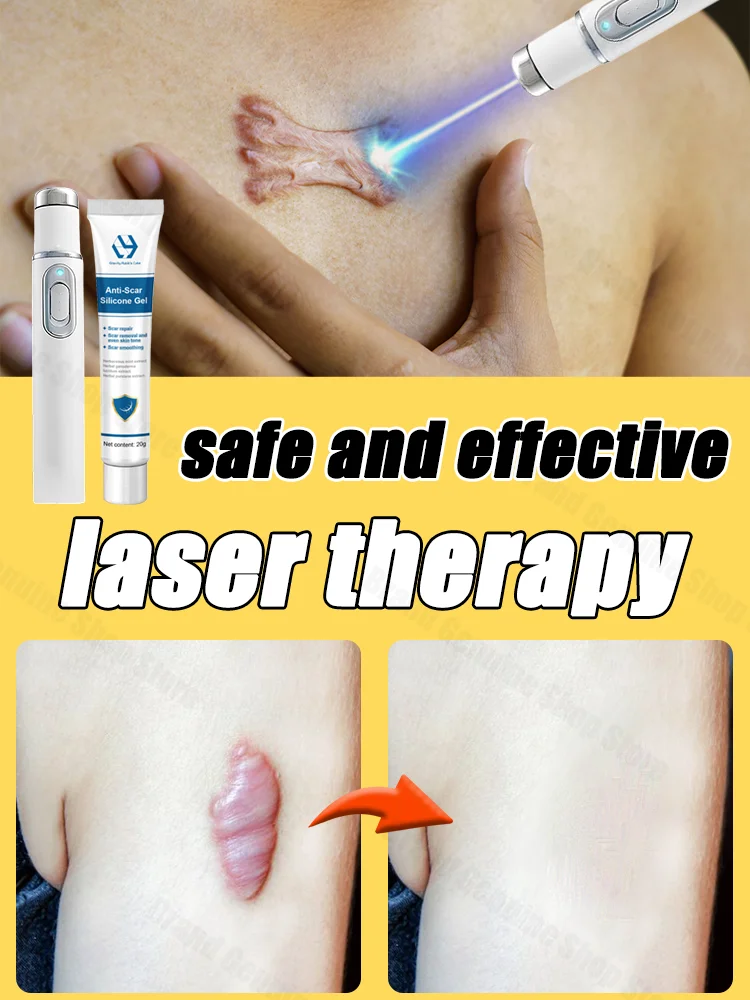 Laser therapy Keloid scar