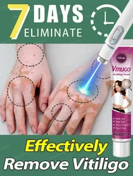 Vitiligo Blue Light Laser Pen