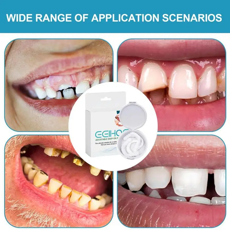 송진 치아 수리 스마일 키트, 조정 가능한 스냅 온 틀니, 임시 틀니, 불완전 치아 커버, 남녀 임시 치아