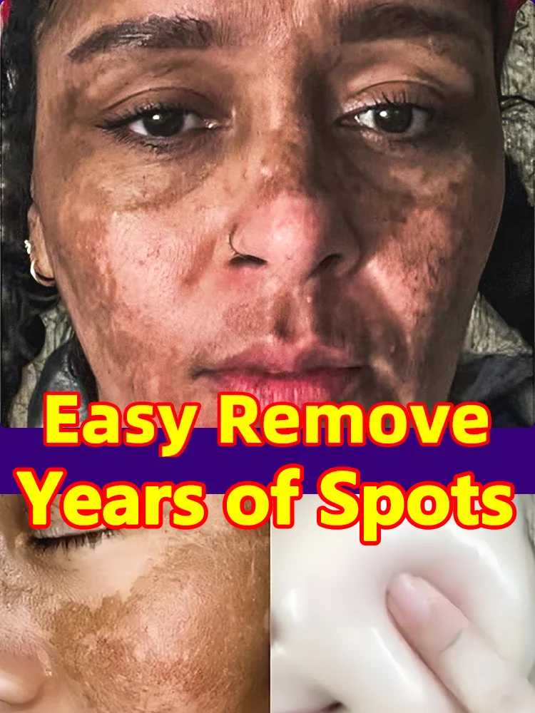 

Freckle Whitening Cream Melasma Removal Dark Spots Fade Brighten