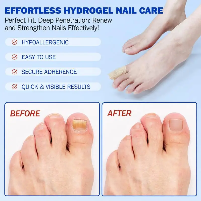 21 個足の爪パッチ柔軟な生地防水爪修理パッチ亀裂変色フットケア通気性陥入爪ステッカー