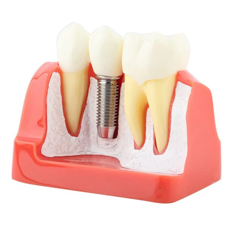Teeth Demonstration Model Implant Removable Analysis Crown Bridge For -Patient Communication