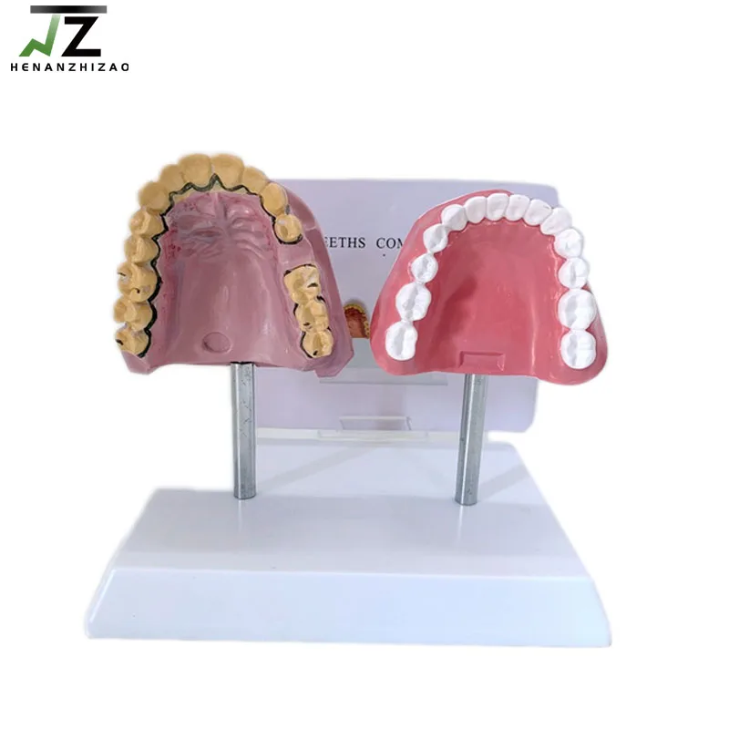 

Human Smoking Tooth and Healthy Dental Pathological Anatomy Comparison Model