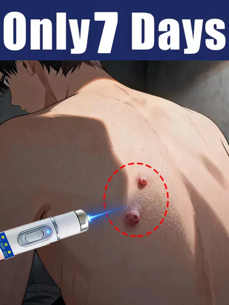 قلم الضوء الأزرق يحل الثآليل، أدوات العناية بالثآليل رائجة البيع 26 #1