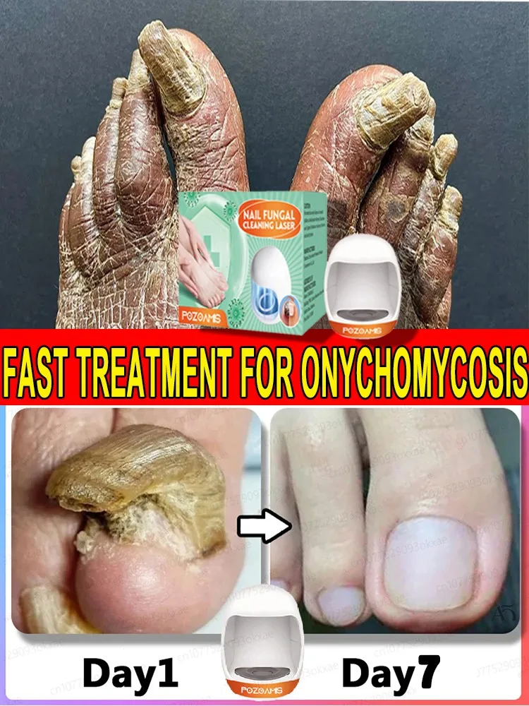 Fungal Nail Repair Fast Onychomycosis Fungus Nails