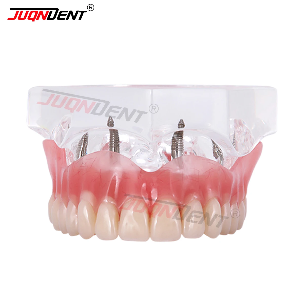 Dental Teaching Model Dental Implants Demo Dental Teeth Model 6001C Dental Upper Overdenture Superior Dental Model Practice Demo