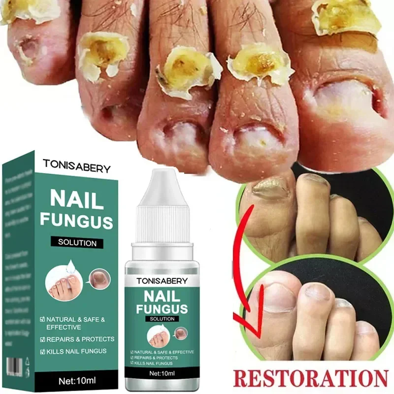 เชื้อราเล็บ Treatment Serum Foot Repair Liquid Toe เล็บ Fungal Removal GEL Anti Infection Paronychia Onychomycosis ครีม 10ml