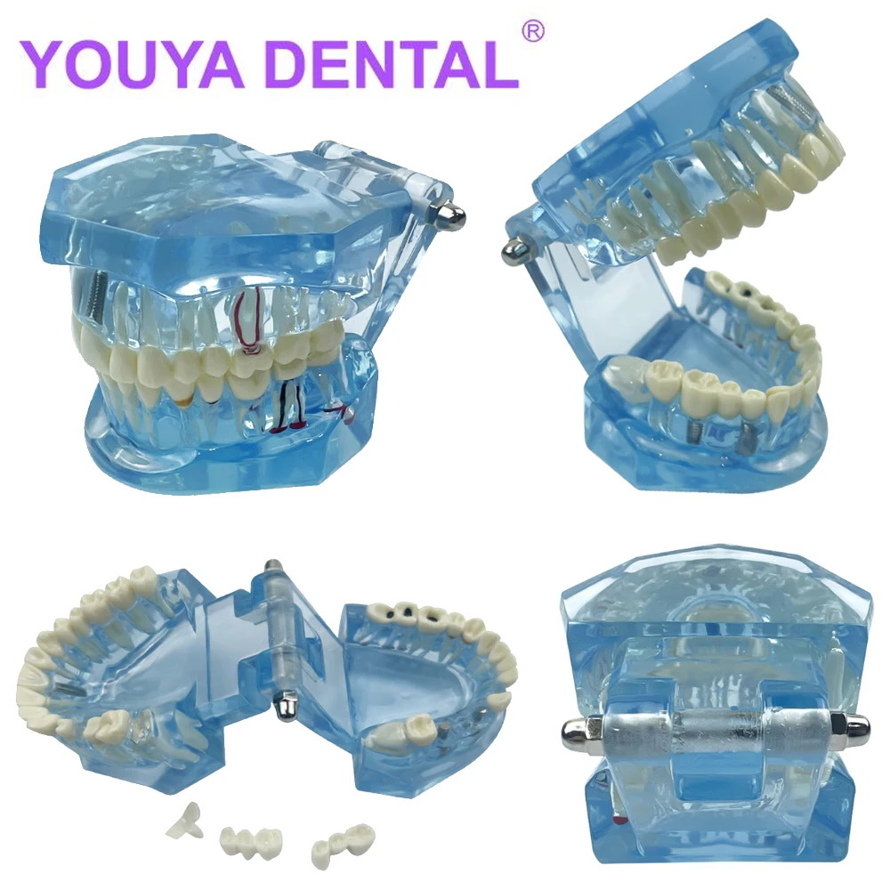 

Dental Implant Disease Teeth Model With Restoration Bridge Tooth For Medical Science Dental Dentist Disease Teach Study Blue