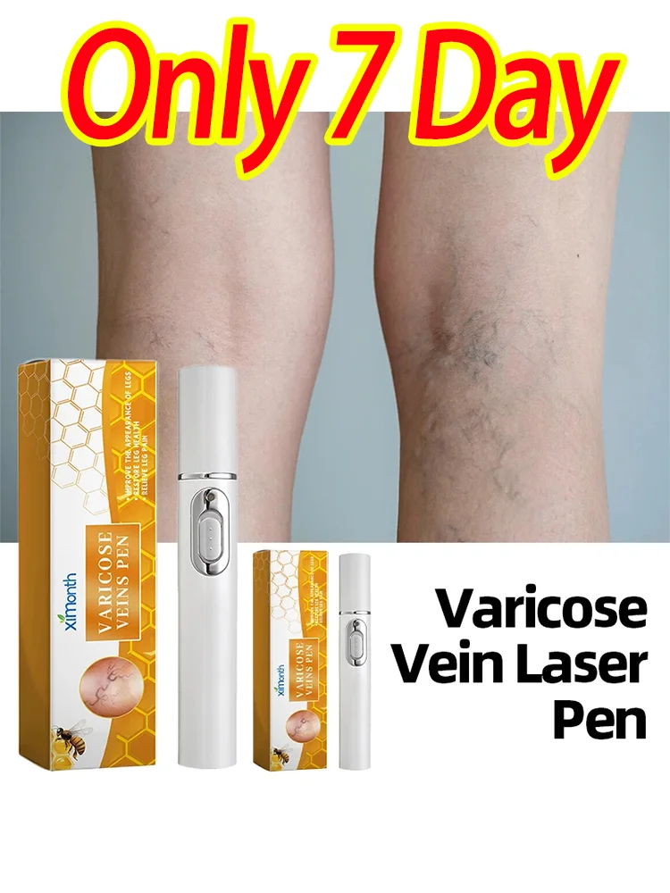 

Varicose Veins Laser Product Relieve Pain And Improve Circulation