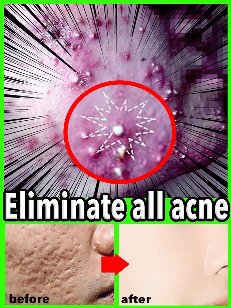 acne remover cream For anti face pimples serum