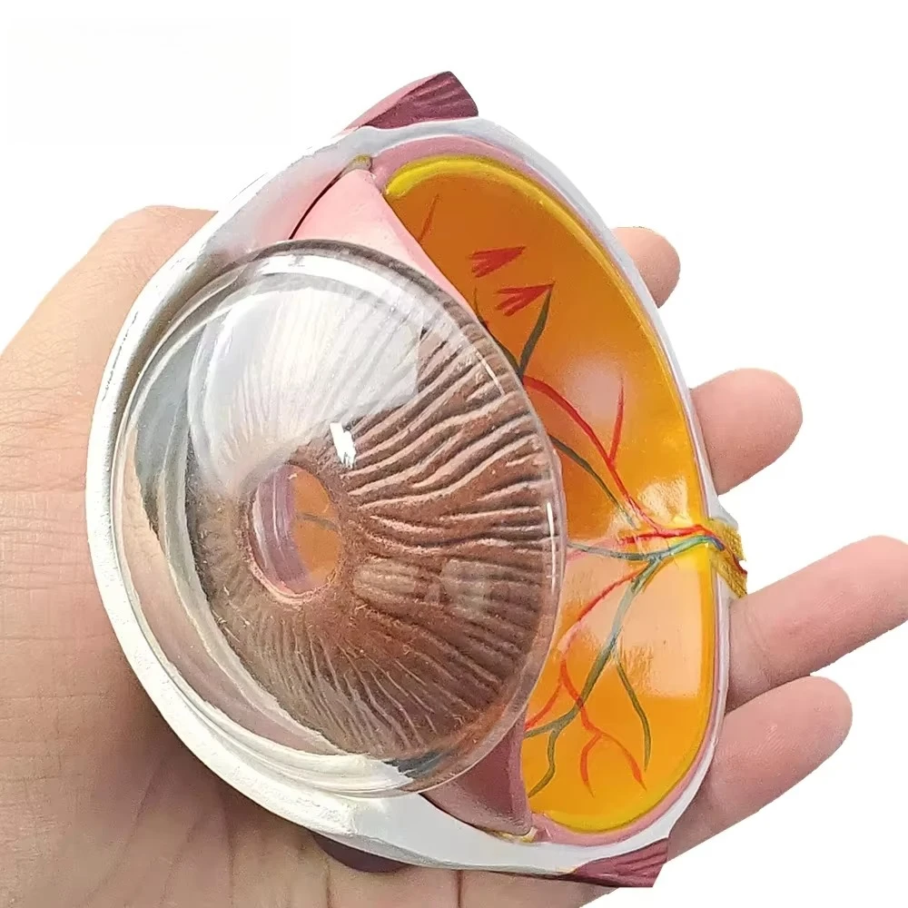 4X Cataract Eyeball Model Eye Various Cataracts Anatomy Teaching and Patient Demonstration Cataract