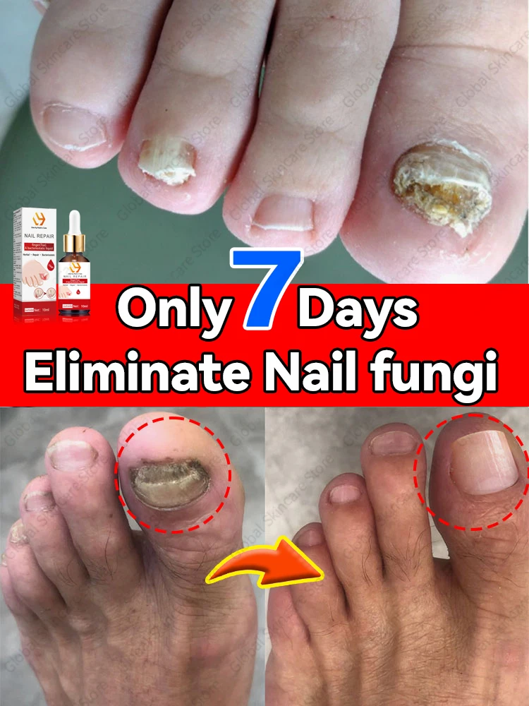 Foot Nail Problems Solved completely