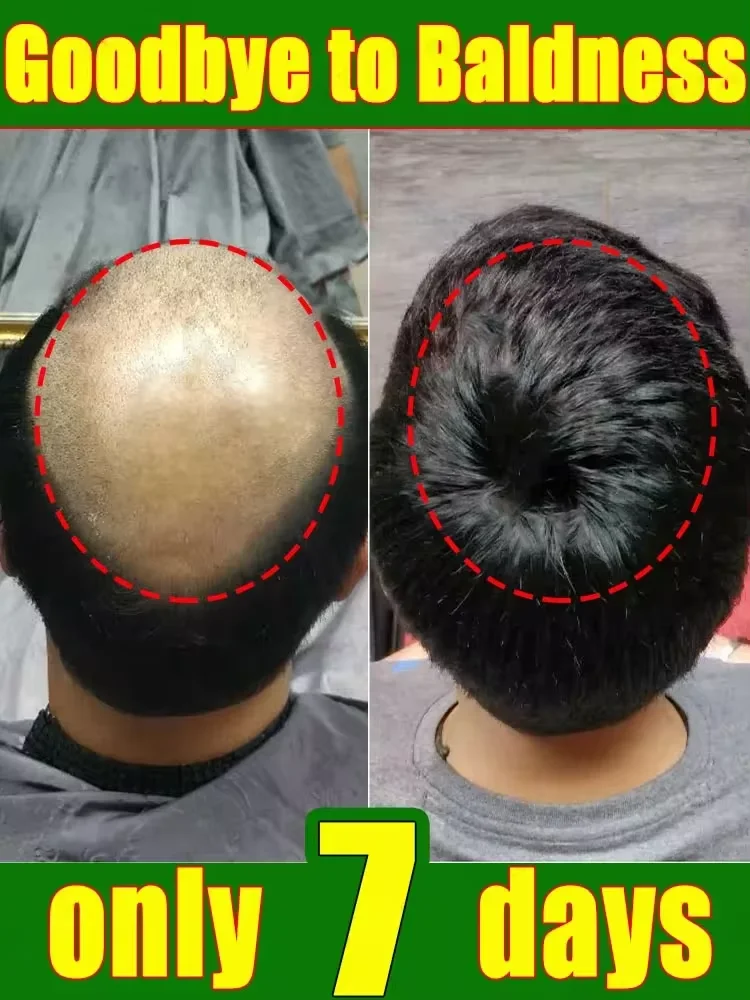 

Hair Fast Growth Product Essential Oil for Men Women Natural Hair Loss Treatment Fast Grow Prevent Baldness Regrowth Thicken Oil