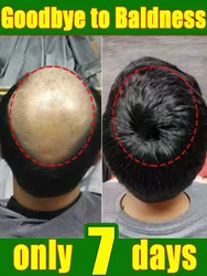 Óleo essencial para o crescimento rápido do cabelo, tratamento natural da perda de cabelo, crescer prevenir a calvície, engrossar o óleo, homens e mulheres