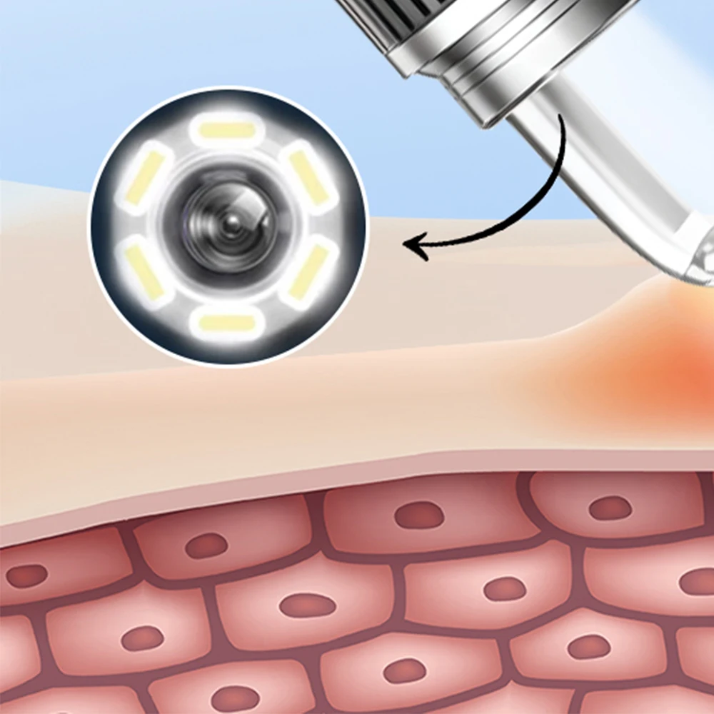 مزيل الرؤوس السوداء البصرية مع كاميرا بثرة بوبر النازع أداة مجموعة أدوات تنظيف المسام لحب الشباب Comedone Whitehead إزالة النقاط السوداء #6
