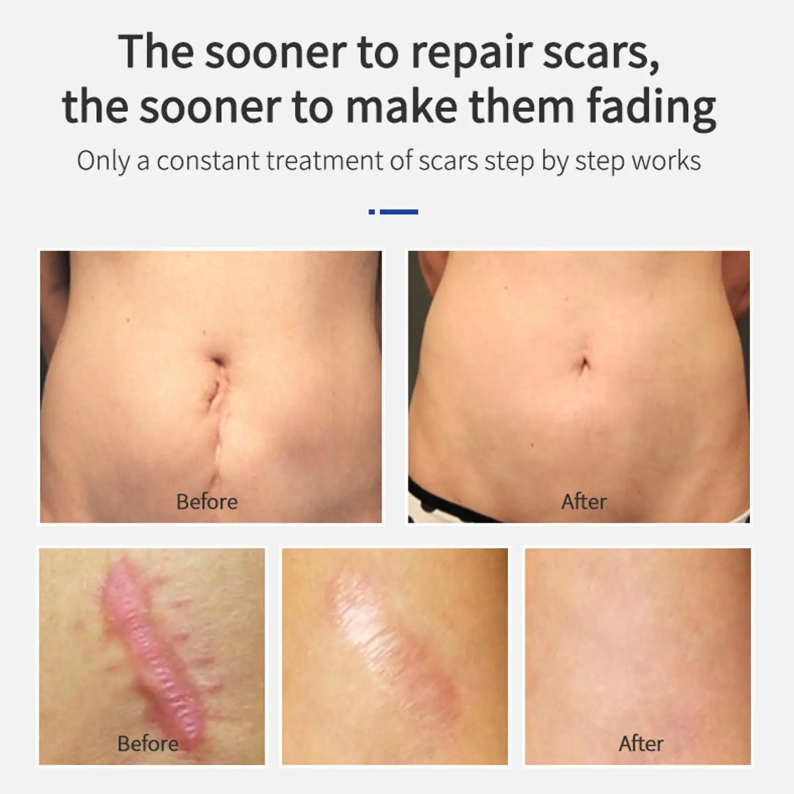 20g Scar Removing Cream Hyperplasia Scar Repairing Gel Remove Acne Spots Treatment Smoothing Whitening Skin Beauty