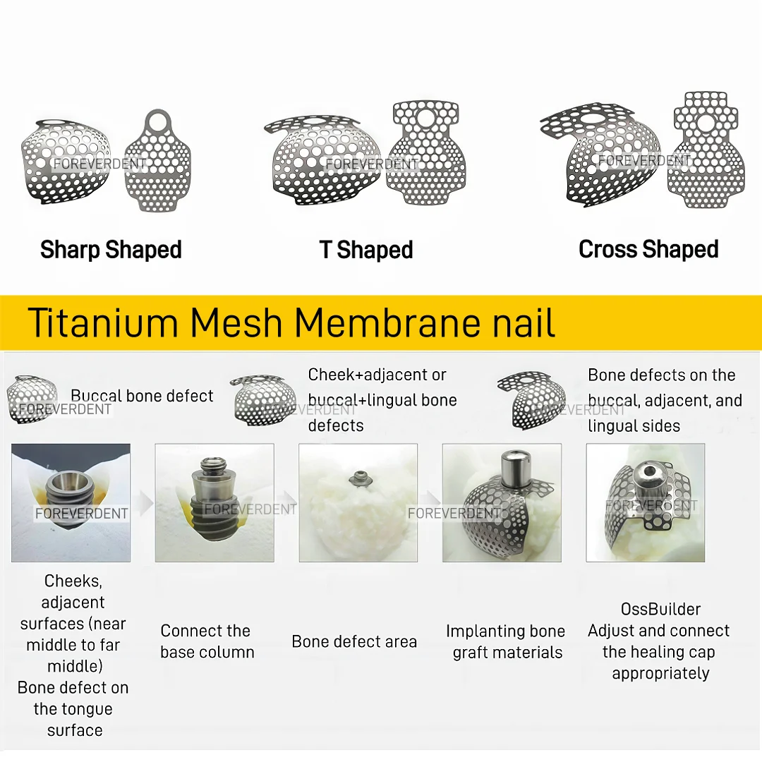 

1PC Dental 1/2/3Wall Titanium Mesh GBR Bone Dental Implant Titanium Mesh Bone Regeneration Nails Flexible and Safety Membrane