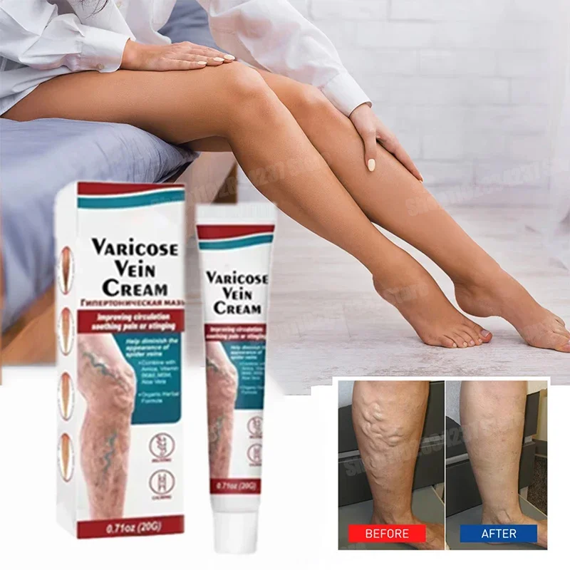 

Leg varicose vein cream - improves blood circulation, reduces spider veins and severe symptoms