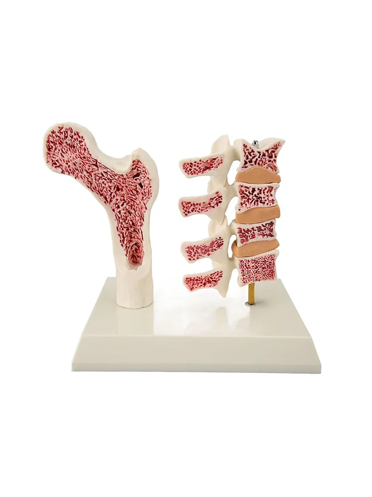 

Анатомическая модель остеопороза человека, скелетные позвонки, поясничный отдел позвоночника, анатомическая медицинская обучающая модель