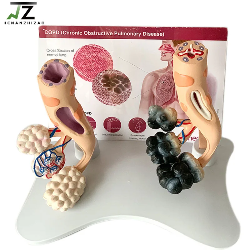 

Human Smoking Lung Pulmonary Alveolar Teaching Model