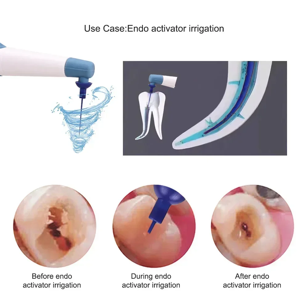 Dental Wireless Ultrasonic Activator Endo Activator Irrigator Washing Tooth Irrigator with 60pcs Tips Root Canal Treatment Tool