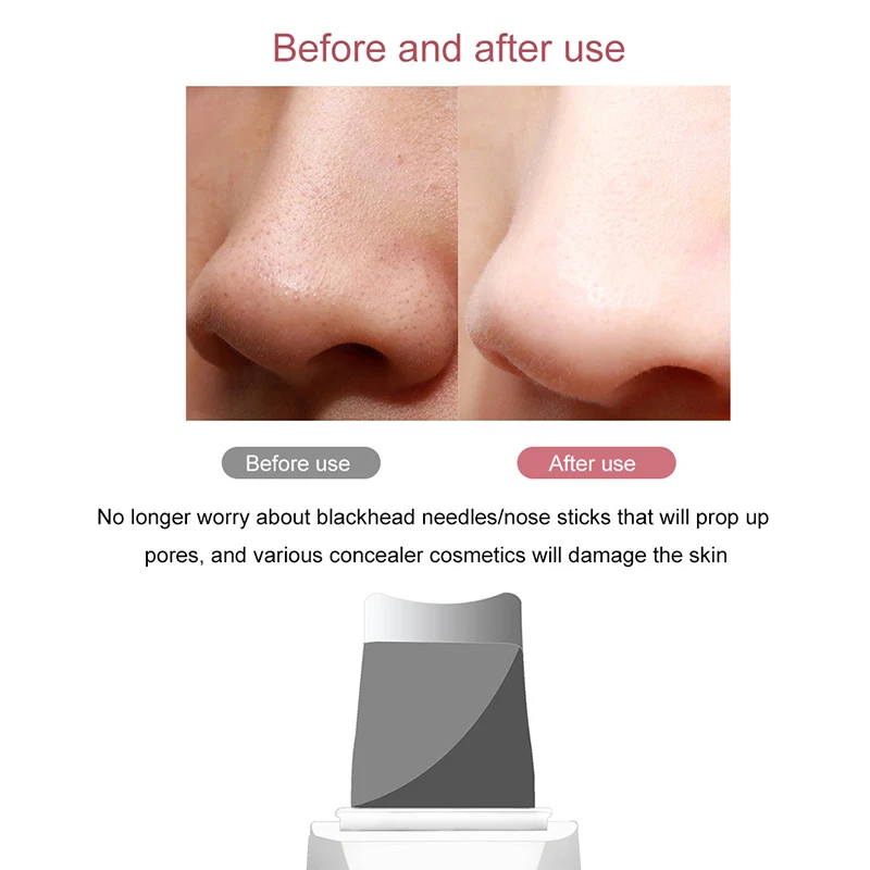 Scrubber ad ultrasuoni per la pelle Peeling Rimozione di punti neri Pulizia profonda del viso Detergente per pori ad ultrasuoni agli ioni