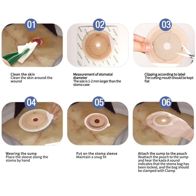 10 PCS AOKI System Ostomy Bags Disposable Colostomy Pouch Ileostomy Bag Opening Drainable Pouch Stoma Ostomy