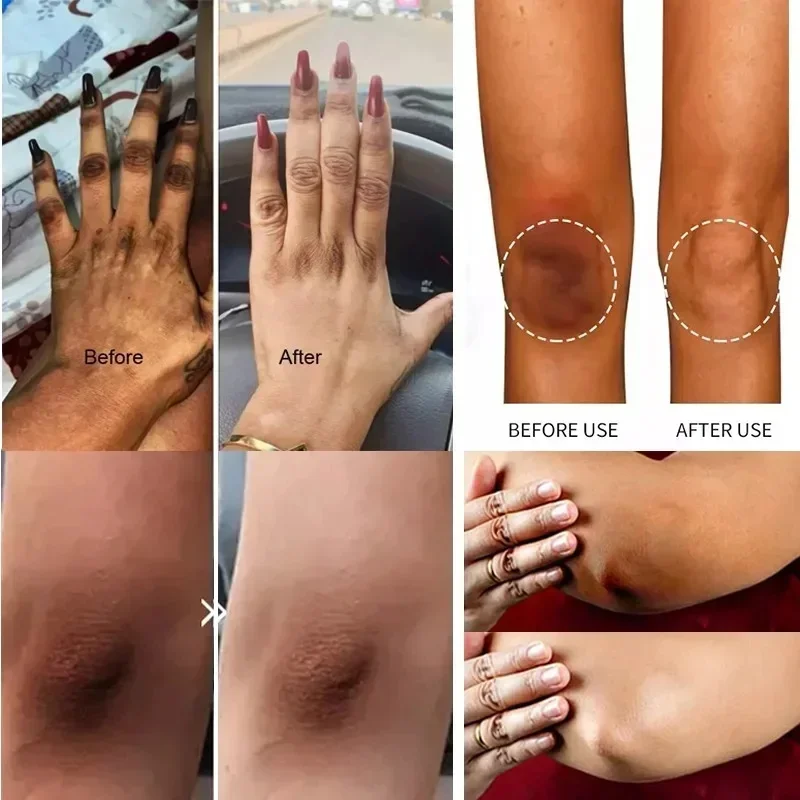 Creme iluminador de nicotinamida para pele escura, eficaz para clarear a lixívia interna da coxa, remove a melanina, partes íntimas, creme iluminador