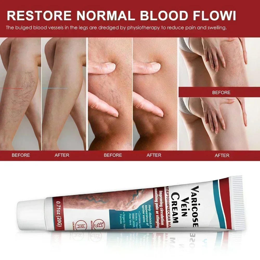 Effective Varicose Vein Relief  Ointment For Varicose Veins