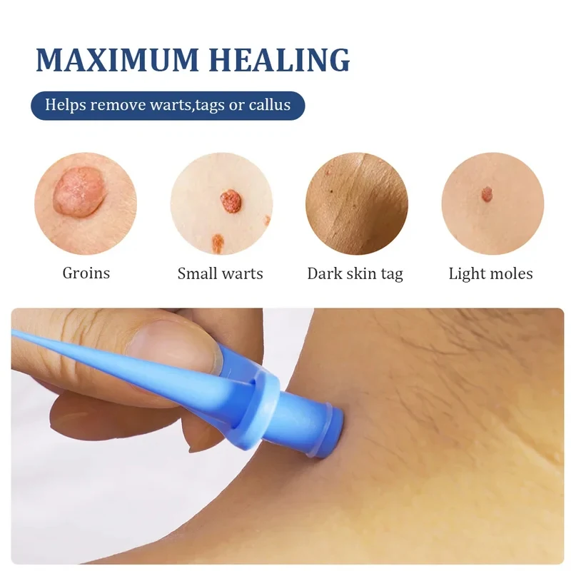 2 In 1 Auto Skin Tag Remover Kit Painless Mole Wart Removal Tool 2-9mm Micro Treatment Skin Care Equipment 6