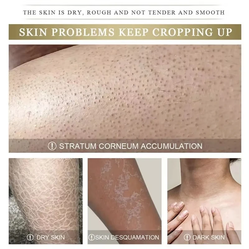 Instant Reduce Chicken Skin Cream Acne Repair Shrink Pores Body Melanin Fade Whitening Smooth Moisturize Skin Health Beauty