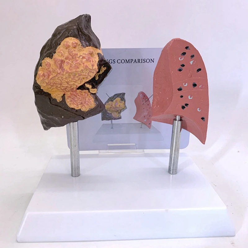 Modelo de pulmão de fumante Modelo de pulmão saudável Modelo de anatomia pulmonar com sistema respiratório patológico Pulmão da doença