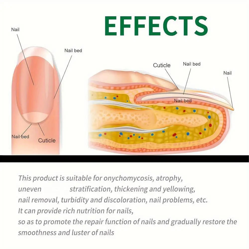 حار 72 قطعة مسمار القدم رقعة إصلاح الإطارات رمادي الفطرية مسمار رشاقته لينة بارونيشيا العدوى اليد مسمار تصحيح ملصق نام أظافر