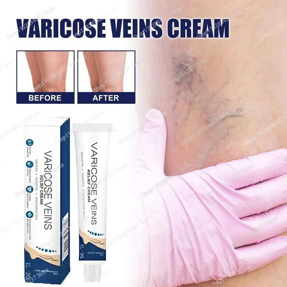 Varicose Veins Remove Red Blood Streaks Varicocele Vasculitis Phlebitis Strengthen Capillary Health