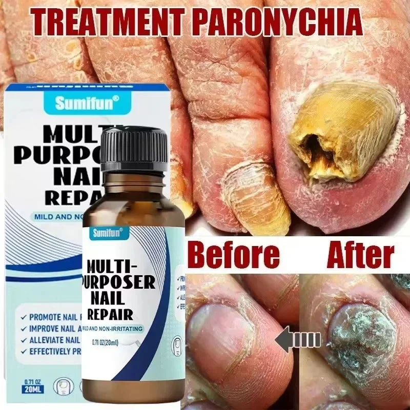 

Fungal Nail Treatment Serum Foot Toe Nail Fungus Removal Repair Gel Anti Infection Paronychia Onychomycosis Foot Nails Care