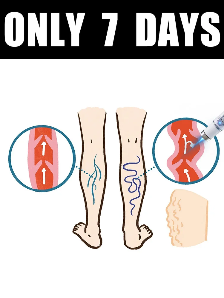 

blue light pen solve varicose veins, hot sale leg care tools