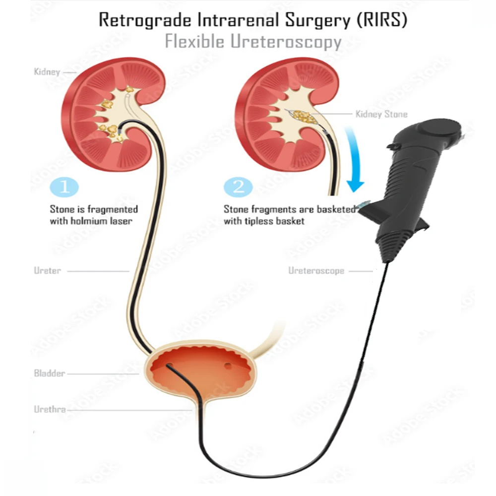 CRW Flexible Endoscopy Ureteroscope with Working Channel Medical Grade Disposable   Digital Veterinary Cmos Sensor  400*400p