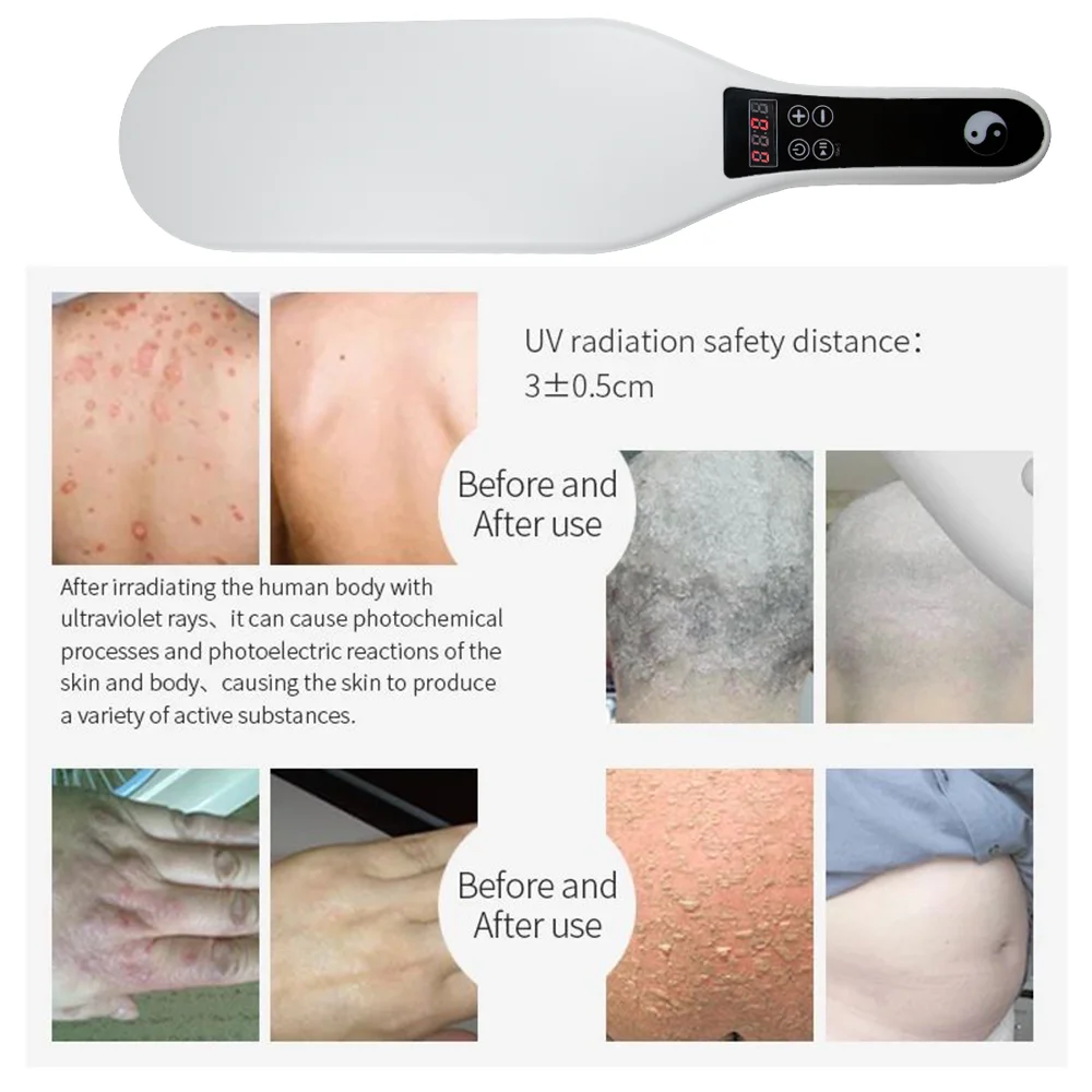 Uvb ランプ理学療法機器狭帯域光線療法乾癬ランプ医療光源 UV Led 311nm Uvb 白斑ランプ