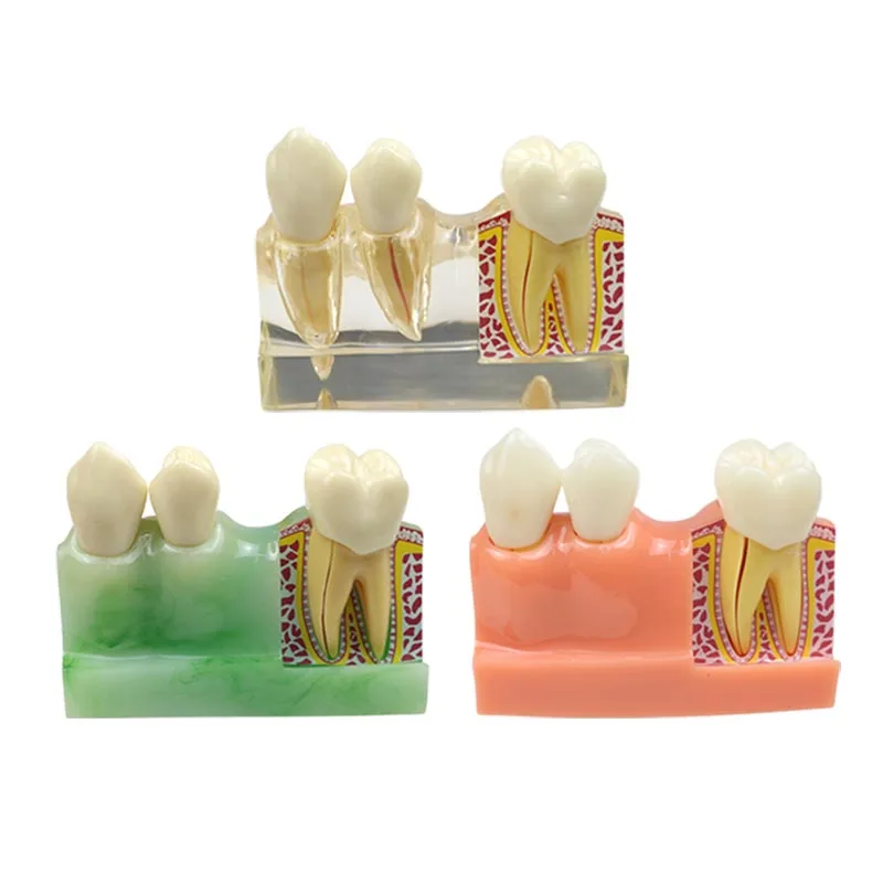 

Dental 4Times Implant Model Caries Comparation Model Dental Demonstrration Teeth Model Dental Materials