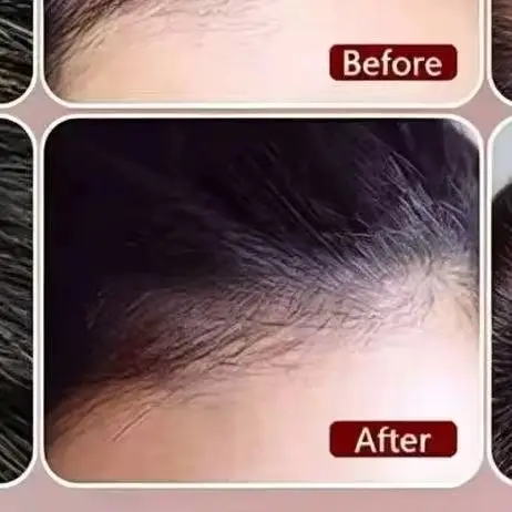 208 Diodes Low Level Laser Cap Professional Hair Growth System LLLT Hair Restoration for Men Women
