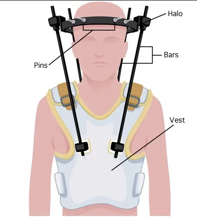 Halo-glaçure médicale professionnelle