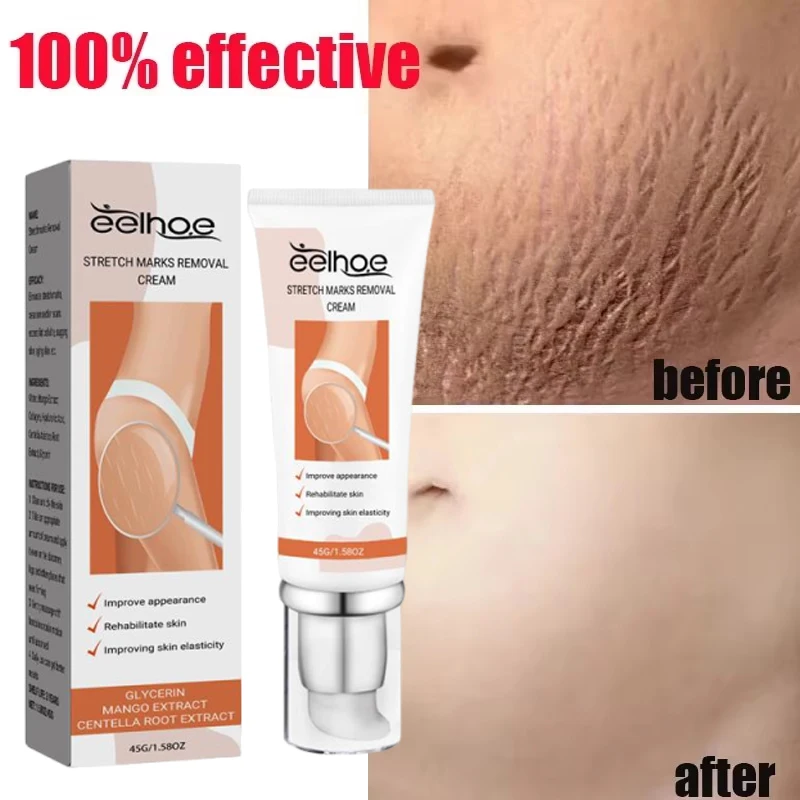 

Stretch Marks Permanent Removal Cream Maternity Pregnant Women Pregnancy Anti-Winkle Smooth Repair Firming Skin Body Skin Care