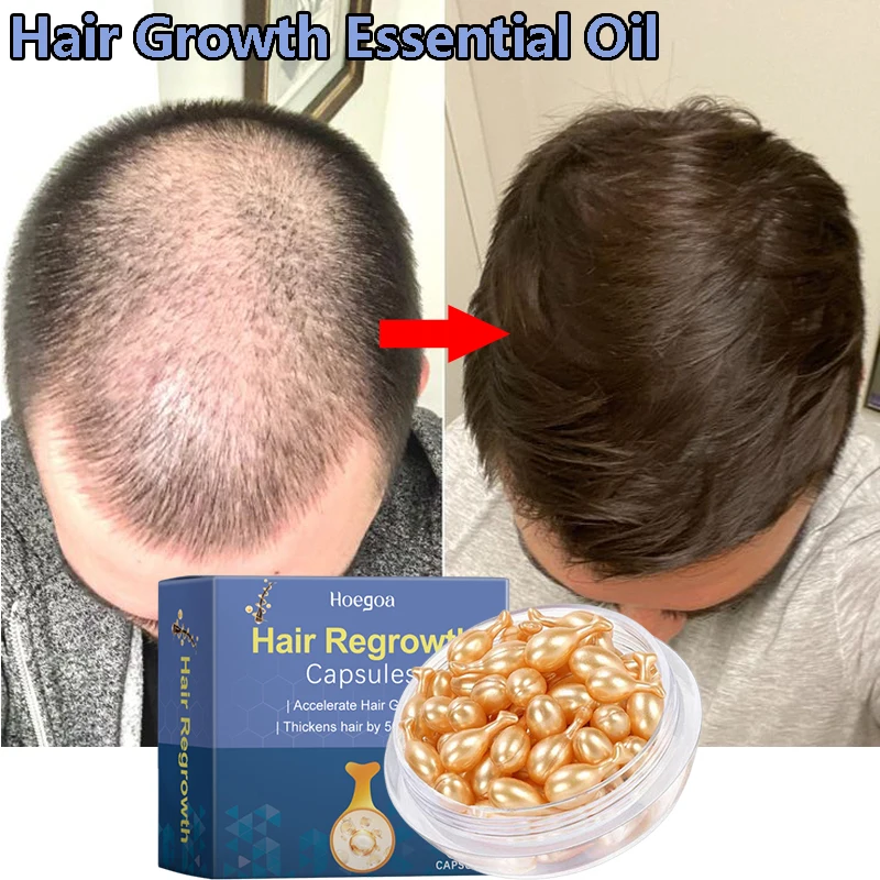 

Сыворотка для роста волос, 7 дней, необходимая капсула для быстрого восстановления волос, против выпадения волос, восстановление облысения, лечение поврежденной кожи головы для женщин и мужчин