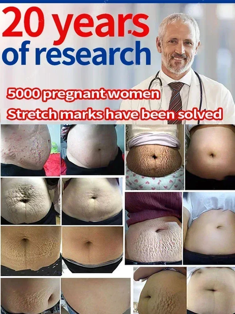 Effective Stretch Marks Permanent Removal Cream Eliminate Body Belly Stretch Marks For Tunnels