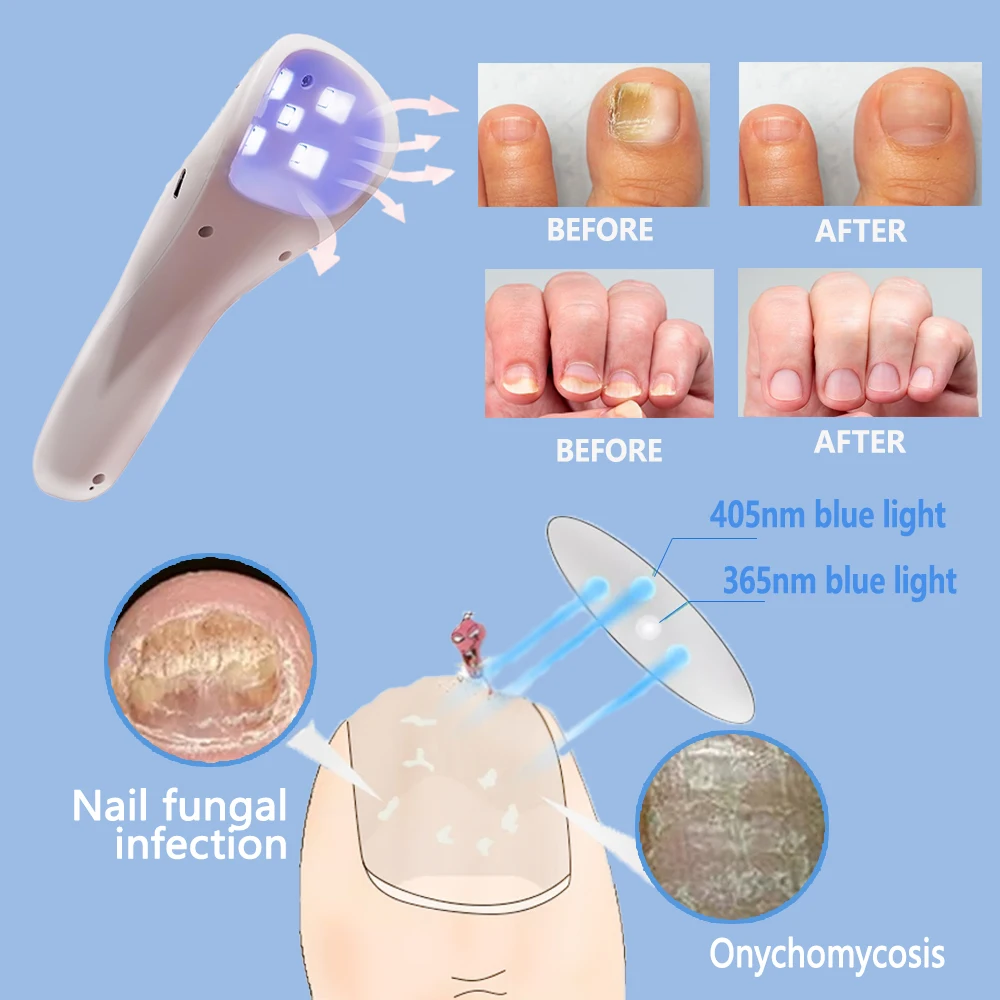 Rechargeable Nail Fungal Treatment Laser Device Fungus Nails Repair Fast Effectively Remove Fungal Nail Repair Solution FootCare